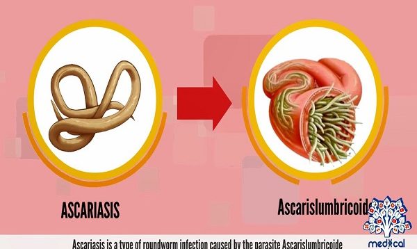 Ascariasis, Causes, Signs and Symptoms, Diagnosis and Treatment.