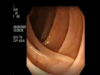 Colonoscopy Demonstrating a Moving Worm NEJM