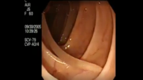 Colonoscopy Demonstrating a Moving Worm NEJM