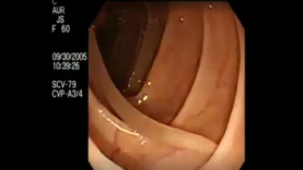 Colonoscopy Demonstrating a Moving Worm NEJM