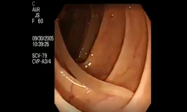 Colonoscopy Demonstrating a Moving Worm NEJM