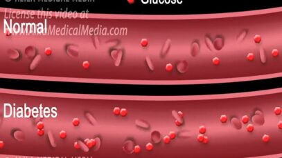 Diabetes Type 1 and Type 2.