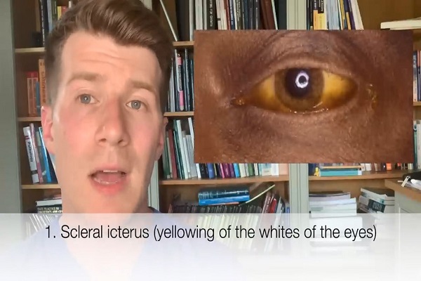 Doctor outlines 7 signs of Alcoholic Liver Disease (ascites, Caput Medusae, jaundice more)