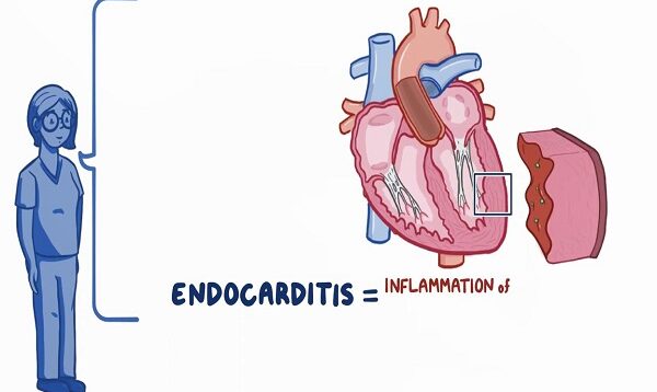 Endocarditis- Clinical Nursing Care