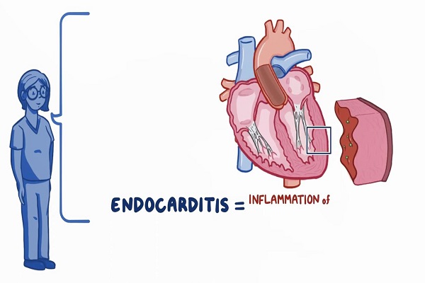 Endocarditis- Clinical Nursing Care