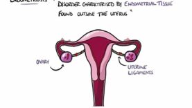 Endometriosis Explained (Signs Symptoms, Diagnosis, Pathology, Treatment)