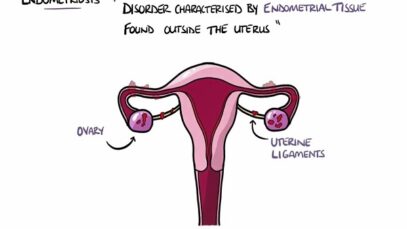 Endometriosis Explained (Signs Symptoms, Diagnosis, Pathology, Treatment)