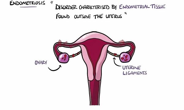 Endometriosis Explained (Signs Symptoms, Diagnosis, Pathology, Treatment)
