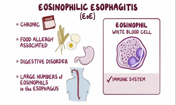 Eosinophilic esophagitis