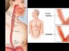 Esophagitis