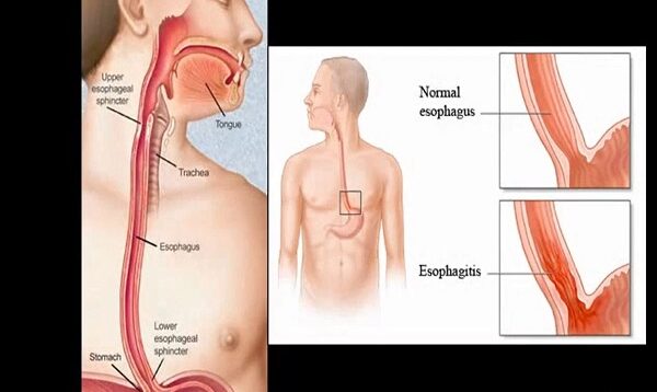 Esophagitis