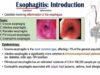 Esophagitis (Esophagus Inflammation)- Causes, Risk Factors, Signs and Symptoms, Diagnosis, Treatment