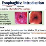 Esophagitis (Esophagus Inflammation)- Causes, Risk Factors, Signs and Symptoms, Diagnosis, Treatment