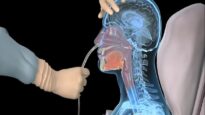 How to insert a nasogastric tube for NG intubation