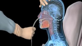 How to insert a nasogastric tube for NG intubation