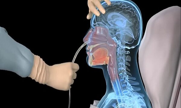 How to insert a nasogastric tube for NG intubation