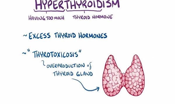 Hyperthyroidism