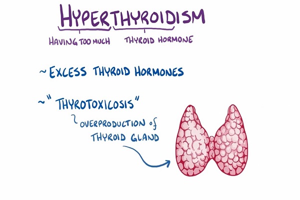 Hyperthyroidism