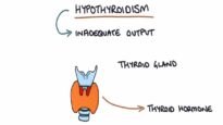 Hypothyroidism and Hashimoto’s Thyroiditis- Visual Explanation for Students