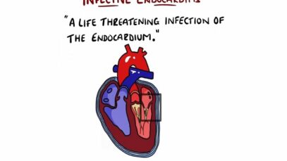 Infective Endocarditis (With Duke Criteria Pathophysiology)