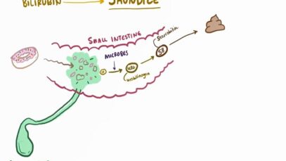 Jaundice – causes, treatment pathology