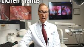 Lichen Planus – Burning Mouth Symptoms – Causes – Treatment