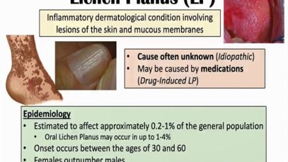 Lichen Planus (“Purple Skin Lesions”) – Causes, Signs Symptoms, Diagnosis, Treatment