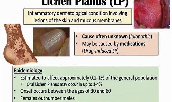 Lichen Planus (“Purple Skin Lesions”) – Causes, Signs Symptoms, Diagnosis, Treatment