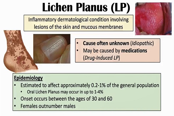Lichen Planus (“Purple Skin Lesions”) – Causes, Signs Symptoms, Diagnosis, Treatment