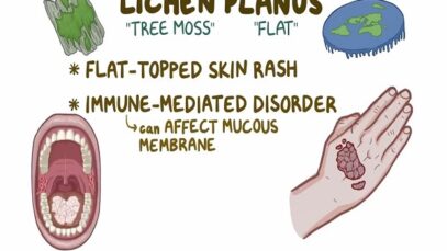 Lichen planus – causes, symptoms, diagnosis, treatment, pathology