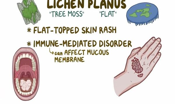 Lichen planus – causes, symptoms, diagnosis, treatment, pathology