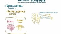 Multiple sclerosis – causes, symptoms, diagnosis, treatment, pathology