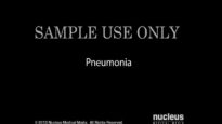 Pneumonia