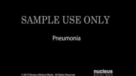 Pneumonia