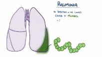 Pneumonia – causes, symptoms, diagnosis, treatment, pathology