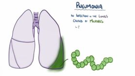 Pneumonia – causes, symptoms, diagnosis, treatment, pathology