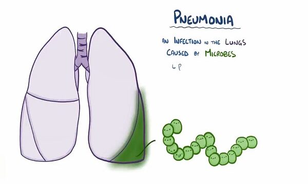 Pneumonia – causes, symptoms, diagnosis, treatment, pathology