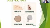 SKULL FRACTURE TYPES- HEAD INJURIES