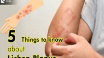 Top 5 Things to Know about Lichen Planus