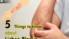 Top 5 Things to Know about Lichen Planus