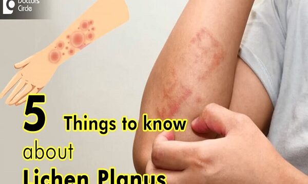 Top 5 Things to Know about Lichen Planus