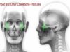 Tripod Other Cheekbone Facial Fractures