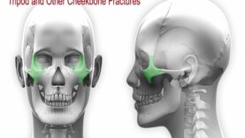 Tripod Other Cheekbone Facial Fractures