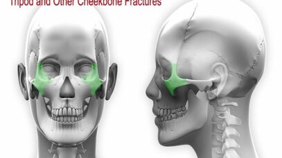 Tripod Other Cheekbone Facial Fractures