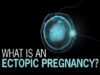 What is Ectopic Pregnancy.