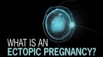 What is Ectopic Pregnancy.