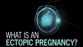 What is Ectopic Pregnancy.