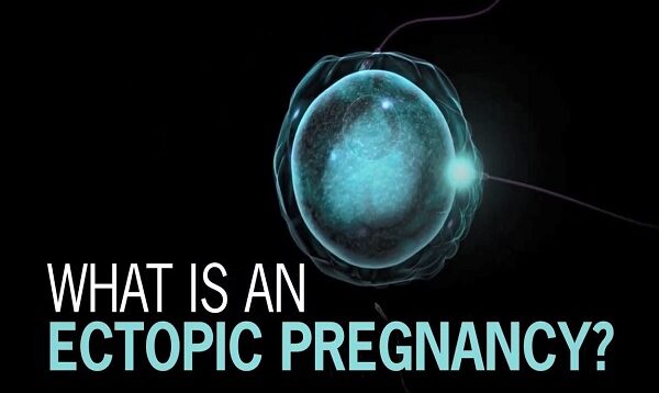 What is Ectopic Pregnancy.