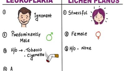 leukoplakia vs lichen planus – 10 points to differentiate clinically