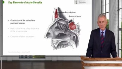 Acute Sinusitis – Infectious Diseases